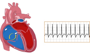 Supra ventricular tachycardia 